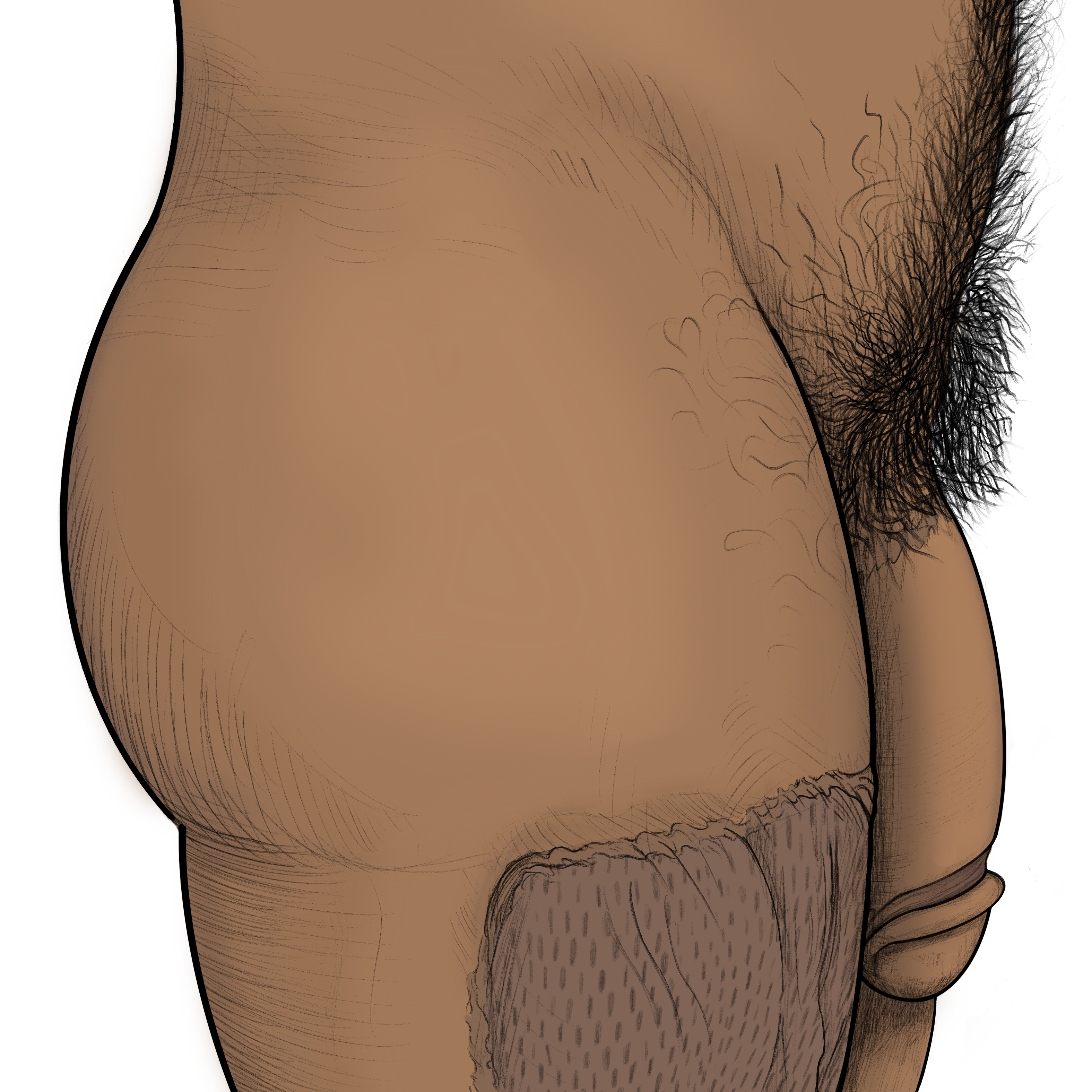 Arm-flap or RFF phalloplasty, showing the front view, the full description is below.